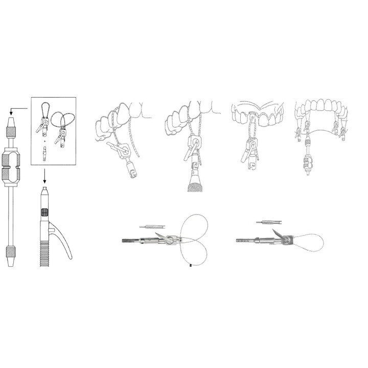Loop end (double loop with lock) for pulling bridges