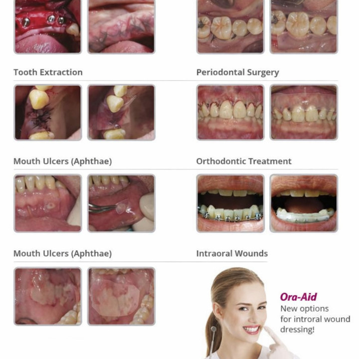 Ora-Aid intraoral dressing